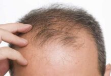 Um a cada quatro pacientes apresentam queda de cabelo após Covid-19