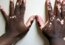 Homem com vitiligo na Bahia tenta provar que é pardo para se manter em curso de medicina