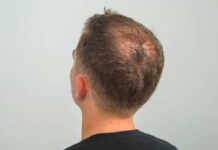 Médicos alertam que inúmeros doentes sofrem de perda de cabelo pós-Covid