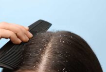 Oito dicas infalíveis para dizer adeus (de vez) à caspa
