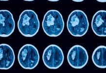 Saiba o que é um AVC e como identificar os sintomas