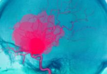 Os aneurismas cerebrais são mais comuns entre estas pessoas