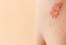 Risco de herpes-zóster aumenta 15% após Covid, revela estudo