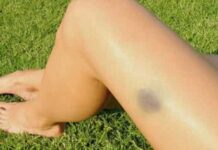 Hematoma que surge espontaneamente pode ser sinal de doenças
