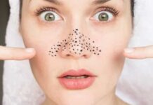 Saiba tudo o que precisa de fazer para remover e prevenir a acne