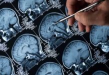 Alzheimer: como exercícios físicos e sono ajudam a prevenir a doença?