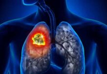 Estudo indica para SUS radioterapia que trata câncer de pulmão em até 5 sessões