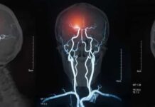 AVC: como identificar os sinais alarmantes de um derrame