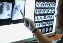 Brasil terá 704 mil novos casos de câncer por ano até 2025 , prevê Inca