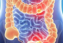 Março Azul: internações por câncer de intestino batem recorde no país