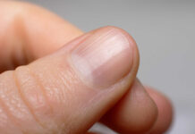 Sabe o que significam os pequenos relevos que tem nas unhas? Entenda!