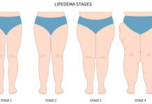 Lipedema: entenda a doença que afeta milhões de mulheres no Brasil