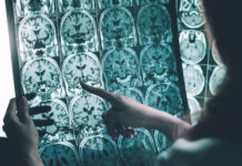 Pessoas negras demoram mais tempo para receber diagnóstico de Alzheimer, aponta estudo