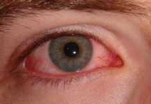 Outono pede mais cuidado com seus olhos