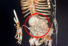 Família autoriza estudo de bebê calcificado por mais de 50 anos no ventre