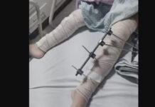 Menina de 6 anos tem pinos colocados em perna errada