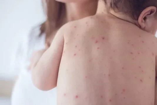 Com 4 casos suspeitos de sarampo, São Bernardo do Campo (SP) deve vacinar bebês