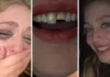 Jovem quebra dente na balada no PR, cola na madrugada e volta para a festa