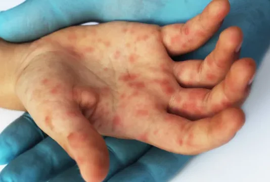 Estado de São Paulo confirma 23 casos de sarampo; 16 não se vacinaram